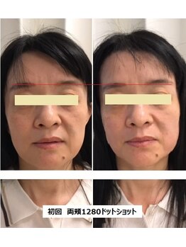 ナチュレアンドメディカ(Nature&Medica)/【たるみor小顔】ウルトラリフト
