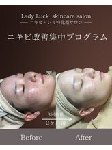 レディラック 大阪梅田本店(Lady Luck)/ニキビ改善集中コース