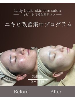 レディラック 大阪梅田本店(Lady Luck)/ニキビ改善集中コース