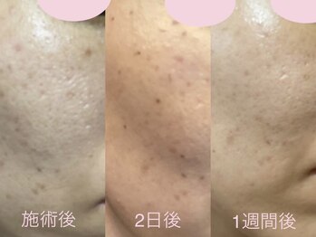 エヴェリーナ(Eveliiina)/シミケア経過写真