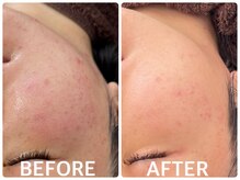 ハーブピーリング 恵比寿/ニキビ/くすみ/毛穴