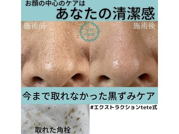 毛穴屋/毛穴洗浄毛穴エクストラクション