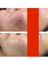 ファルファラ(farfara)/天然ハーブピーリング