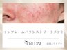 敏感肌や赤み肌で、刺激に弱くなってきた方