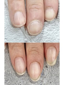 リファーレ(RIFARE)/【深爪矯正】1年後の変化◎