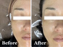 ホッコリ 段原店(HOKKORI)/効果実感No.1BBL光フェイシャル