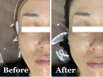 ホッコリ 段原店(HOKKORI)/効果実感No.1BBL光フェイシャル