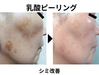 ラディアント たまプラーザ/乳酸ピーリング(スノーピール)