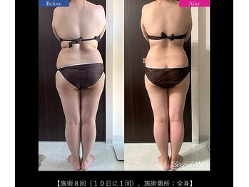 シアン(CYAN)/全身８回施術