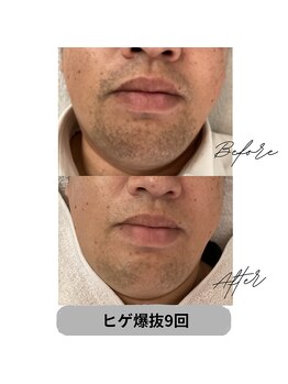 プレジール 大野城店(plaisir)/ヒゲ脱毛