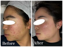 ノア 新宿(Noa)/ハーブピーリング＋マシン 3回