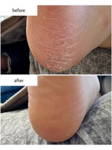 ケアプラス(care plus)/足裏角質ケア
