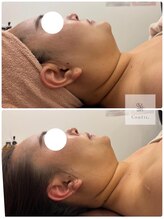 マシェリ 吉祥寺(Macherie)/小顔溶解剤