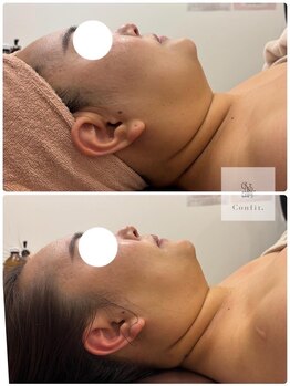 マシェリ 吉祥寺(Macherie)/小顔溶解剤