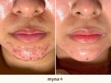 マイナプラ 表参道(myna+)の雰囲気（【原因不明な肌荒れ】どんなお悩みもマイナプラへお任せ下さい。）