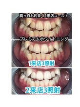 プラチナムビューティ 四条烏丸店(PLATINUM Beauty)/【プレミアムホワイトニング】３