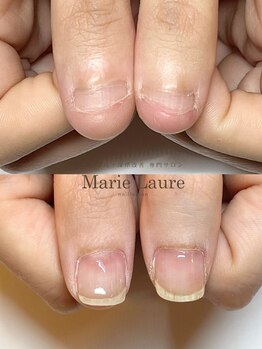 マリーロール 梅田店(Marie Laure)/自爪育成/深爪矯正/ネイルケア