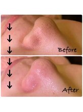 アルルプラス 山科(ARuru+)/【毛穴エクストラクション】