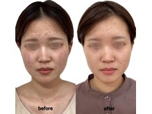 けいのき鍼灸整骨院/美容鍼3ヵ月8回の効果！美容鍼灸