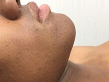 美容脱毛専門サロン エピラージュ 新宿店(Epilage)/黒い肌の方でもOK！