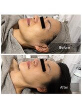 ラペ(la paix)/フェイシャル症例写真/40代