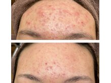 ファルファラ(farfara)/天然ハーブピーリング 