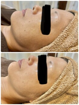 サロン ド ビューティー ラ デュース/シミケアモニター様