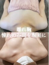 ロココ 豊田店(Rococo)/ビフォーアフター（離れ乳）