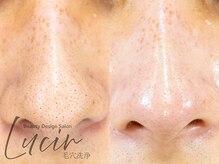 ルシール 仙台店(lucir)の雰囲気(高濃度水素水で毛穴汚れ撃退!くすみを改善し肌トーンもUP★)