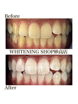 ホワイトニングショップ 妙高店(whiteningshop)/継続ケアの結果をご紹介