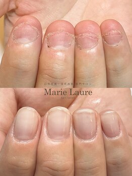 マリーロール 梅田店(Marie Laure)/自爪育成/深爪矯正/ネイルケア