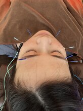 ハリファ鍼灸院 横浜関内院(HariFa鍼灸院)/美容鍼