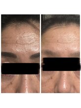 すっぴん美肌革命/額テカリ・しわがスッと落ち着く