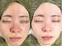 ベル 布施店(Belle)/ハーブピーリング｜ニキビケア