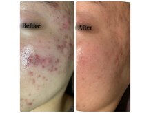 ラグーナ(Laguna)の雰囲気（未来の肌が変わる!ヒト幹細胞導入型!次世代ハーブトリートメント）