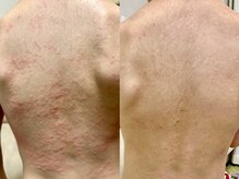 エミナル(eminal)/ビフォーアフター/ニキビ/梅田