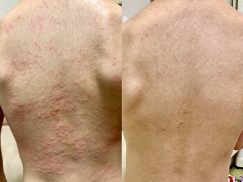 エミナル(eminal)/ビフォーアフター/ニキビ/梅田