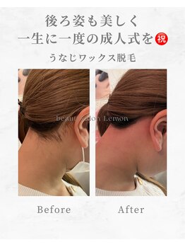 ビューティーサロンレモン(Lemon)/広島でうなじ脱毛ならLemon