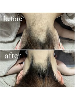 クレセント(crescent)/襟足脱毛