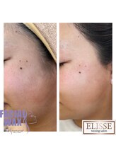 エリス(ELISSE)/耳上の毛もなくなり横顔スッキリ