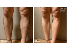 セラス(CERAS)/男性の足脱毛