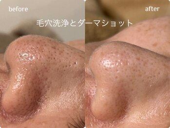 ワイスリー(Y3)/肌質改善コース