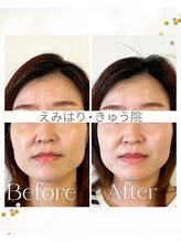 えみはりきゅう院/ひどい噛み締めに☆電気美容鍼