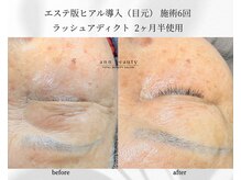 アン ビューティー(ann beauty)/施術6回【症例写真】80代