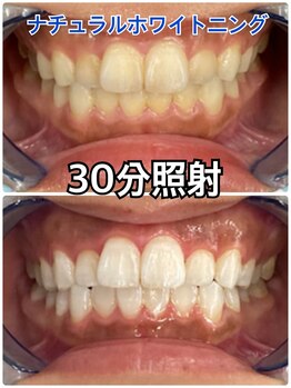 プラチナムビューティ 四条烏丸店(PLATINUM Beauty)/【ナチュラルホワイトニング】