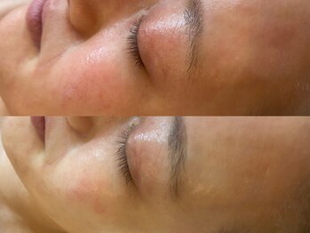 ブラン ネージュ(Blanc Neige)/レストセルトリートメント