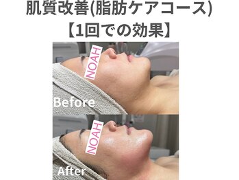 ノア 川越店(NOAH)/肌質改善・小顔