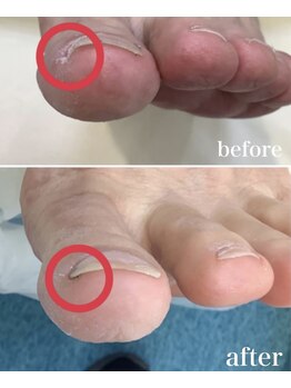 リゼラアンドコー 布施店/食い込んでいたい巻き爪カット！