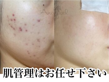 アンドピエル(AndPiel)/確実な変化を求めるならこの施術