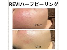 ルアーナ(Luana)の雰囲気（ニキビ　毛穴ケア　一度の施術後でこの変化！）